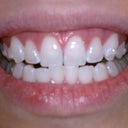 Day 1 - little gap btwn my 2 front teeth. 5 buttons total