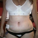 1 week POST-OP. TT scar w one drain.  Still really swollen.