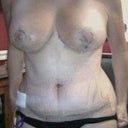The whole body look @ 1 wk post-op.  Very swollen around the TT and hips.