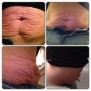 Close up of the extra skin... It is very unpleasant. Ill still have stretch marks but at least they will be pulled tight.
