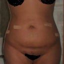 12/11/08 still swollen most discomfort is gone.