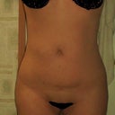 4/18/09 Still seeing slight results but more importantly I am motivated to take better care of my investment, I have started exercising and eating better and feel great!
