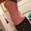 side 1 week post op