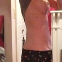 other side 1 week post op, this side is more swollen