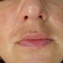 Front/The redness RESEMBLES the "RACCON MASK"  /then there are some small brownish spots