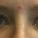 Eyelids before surgery 09/2011