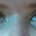 Eyelids after surgery: 1 week 11/2011