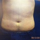 Nearly flat! 9 Days Post Op! Still swelling so it'll be flatter!