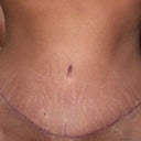 7 weeks after tummy tuck surgery