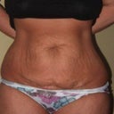 before tummy tuck surgery