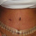 incision across bikini line