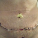 PO day 2. I was too scared to pull the gauze out of my belly button :)