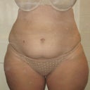 5 Weeks Post (front)