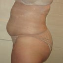 5 Weeks Post (side)