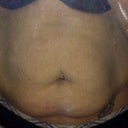 Torn the muscle by a fist and a half from 2 pregnancy with polyhydromnios  4 pregnancy all up