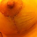 11 Days Post Op Right