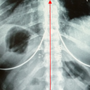 The black circles are air pockets in my body, not the implants. Or so the Chiropractor says.... =) 
The right side of the xray is my right side. Imagine my back is facing you.
The red arrow is just looking at the alignment of my spine- so disregard that.
My bigger implant is on the right (which is my right side) and smaller one on left (left side)