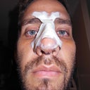 Post-Op +7 Inside Splints removed