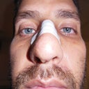 Post-Op +9. Splint removed and no more itching!. Everything looks pretty good to me. Nose is straight, left nostril is only a little bit bigger due to swelling and the tip is large also due to swelling. hopefully the septum will heal well since it looks pretty bad right now.