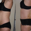 Post Op Day 6 
Before and After
