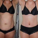 Post Op - Day 6
Before and After