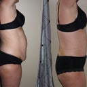 Post Op - Day 6
Before and After