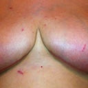 6 weeks post op