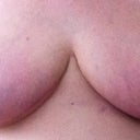 3.5 months post op