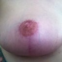 Right nipple graft 3.5 months post op