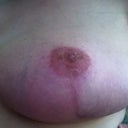Left nipple graft 3.5 months post op