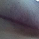 Right side incision 3.5 months post op