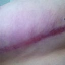 Left side incision 3.5 months post op