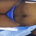 Me after the mark up, vallum and motrin(given by dr to relax me) @ 9:30, stomach and thigh vaser preparation