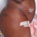 Sunday 2/26/12, the day after lipo. The fluid leakage is gross, a lot of swelling. I felt a lil poking , a lil tenderness not severely.
