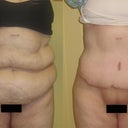 4 months after tummy tuck 