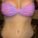 4 months post op