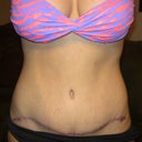 The scar at 4 months. Still red, but in remission :)