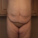 Pre-op front view.