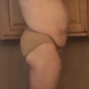 Pre-op side view