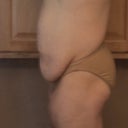 Pre-op side view