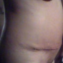 Side of view of scar and progress.. Still some swelling. I feel like I am doing really well so far.