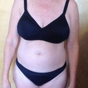 Pre-surgery December 2012