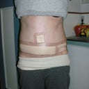 3 days post op - front