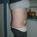 3 days post op