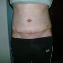 1 week post op