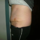 1 week post op