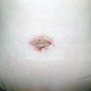 belly button 1 week post op, looks weird!!