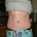 2 weeks 3 days, have got micropore tape on, i'd heard that it made your scars flat