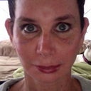 3 weeks post op