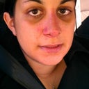 This was taken immediately after the cast was taken off and the sutures were taken out